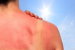 5 mẹo “cấp cứu” da cháy nắng đơn giản tránh làm da bị tổn thương, xuống cấp – Làm đẹp