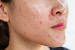4 bước skincare cần làm ngay khi da có mụn – Làm đẹp