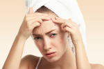 Chăm sóc da sau nặn mụn để chống tình trạng sẹo thâm lâu mờ – Làm đẹp