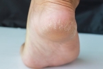 3 cách khắc phục tình trạng gót chân nứt nẻ khô ráp ngày lạnh nàng nên thử áp dụng – Làm đẹp