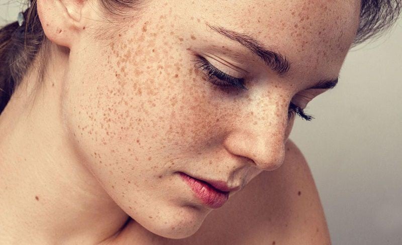 Tại sao phụ nữ hay nám da hơn đàn ông và cách xử lý cho làn da bớt nám như đàn ông – Làm đẹp