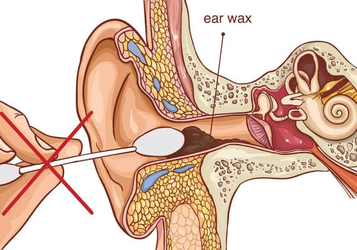 Làm sạch tai như thế nào là an toàn? – Làm đẹp