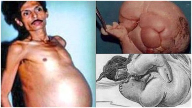 Người đàn ông mang trong mình “thai chết lưu” suốt 36 năm, bào thai nặng 4kg, có cả tóc và tay chân – Khám phá
