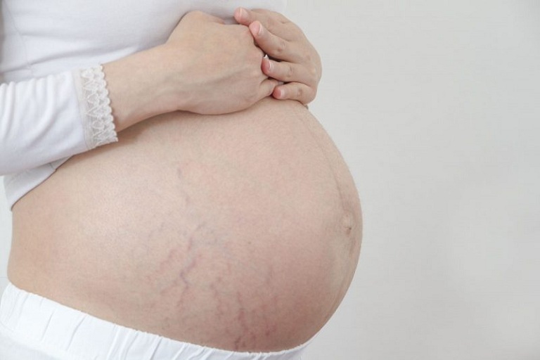 Mách chị em cách làm mờ vết rạn da khi mang bầu an toàn hiệu quả – Làm đẹp