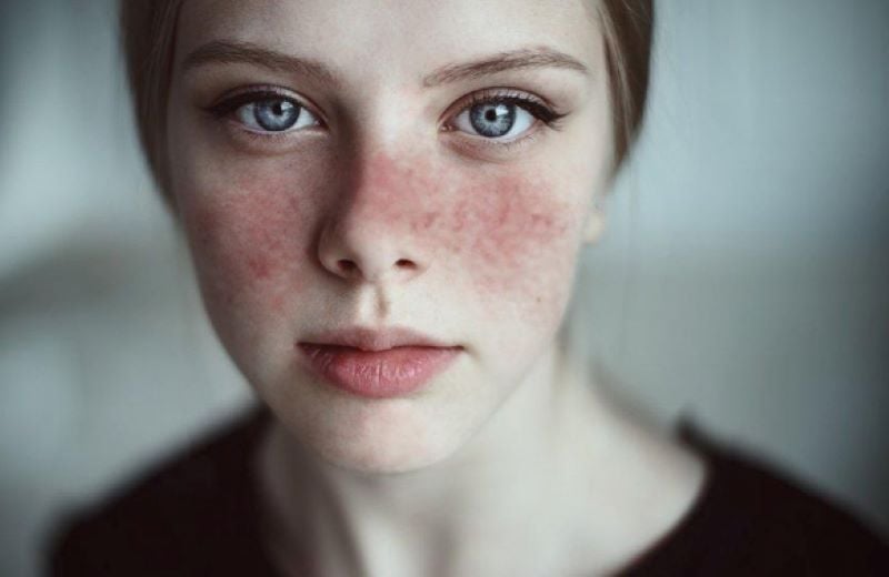 4 kiểu tổn thương da thường gặp phải và cách khắc phục đơn giản – Làm đẹp